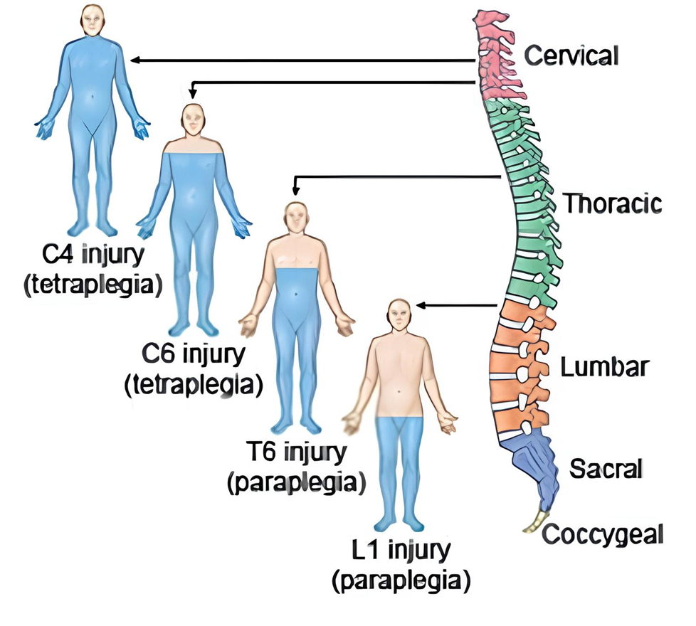 Нарушение иннервации туловища в зависимости от уровня повреждения спинного мозга.