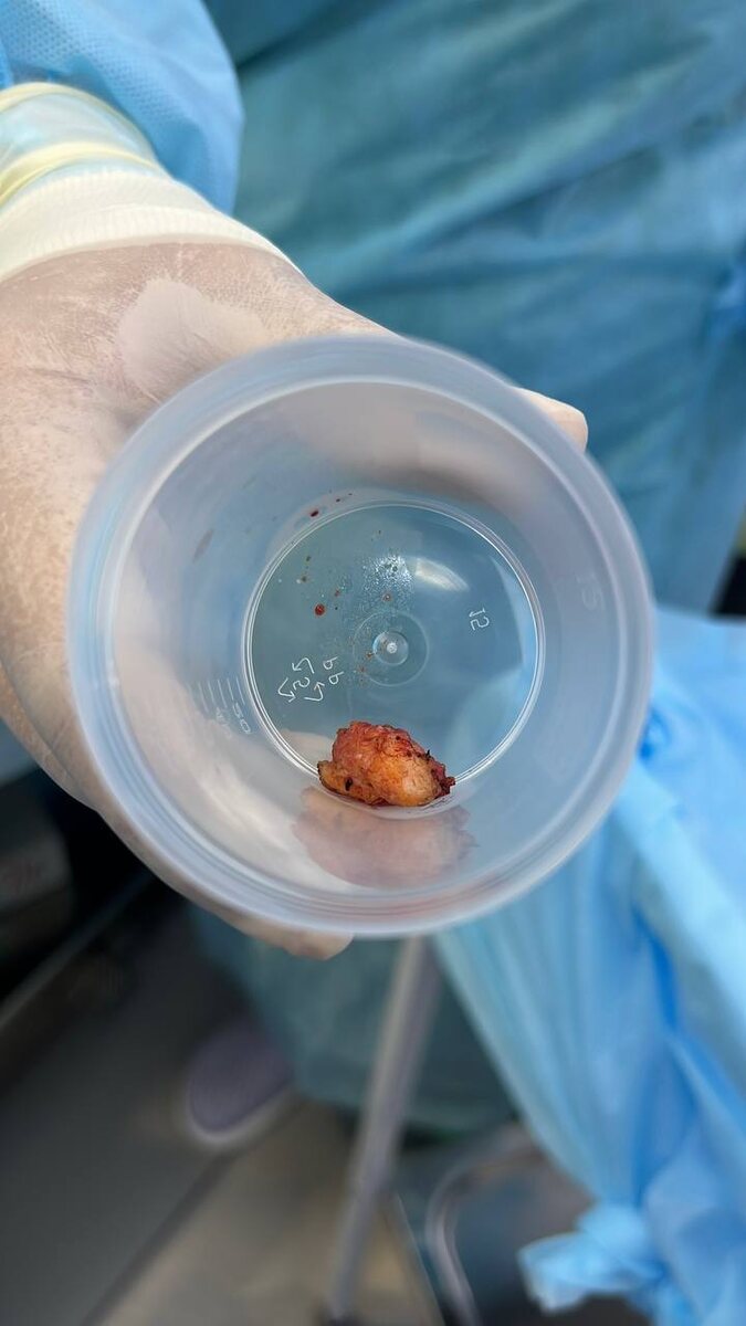 На фото —> кусочек удаленной ткани молочной железы с фиброаденомой (всегда отправляем на гистологическое исследование 🔬))