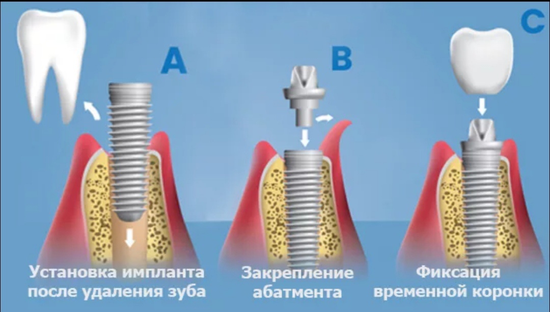 Одномоментная имплантация