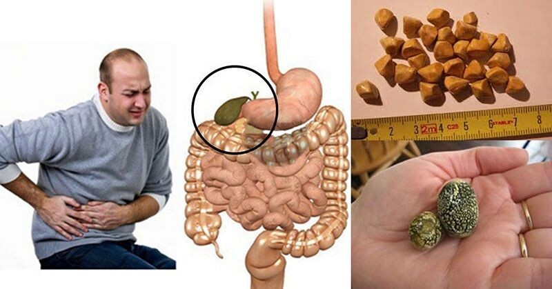 5 признаков камней в желчном пузыре: как распознать проблему и что делать