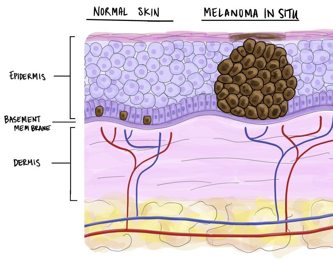 Меланома in situ