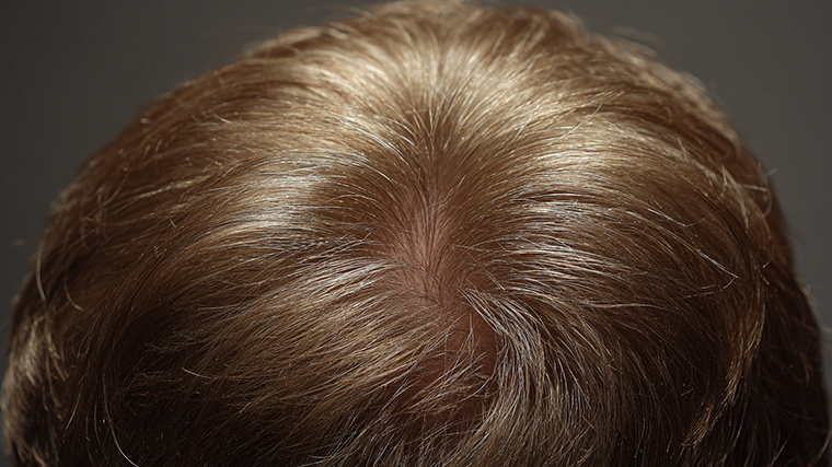    Волосы после пересадки 5-tv.ru