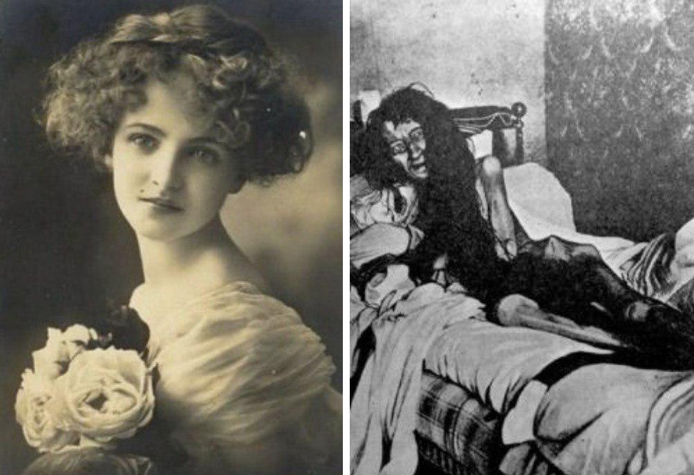 Бланш Монье, французская девушка, до и после обнаружения в комнате, в которой она была тайно заключена на 25 лет