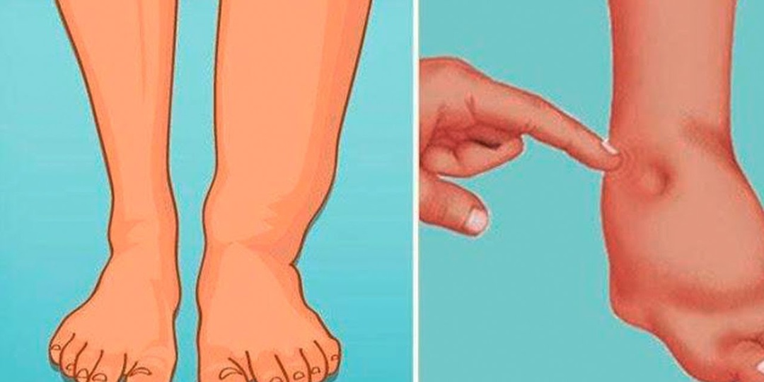 Отекшие ноги вечером: сердце или вены?