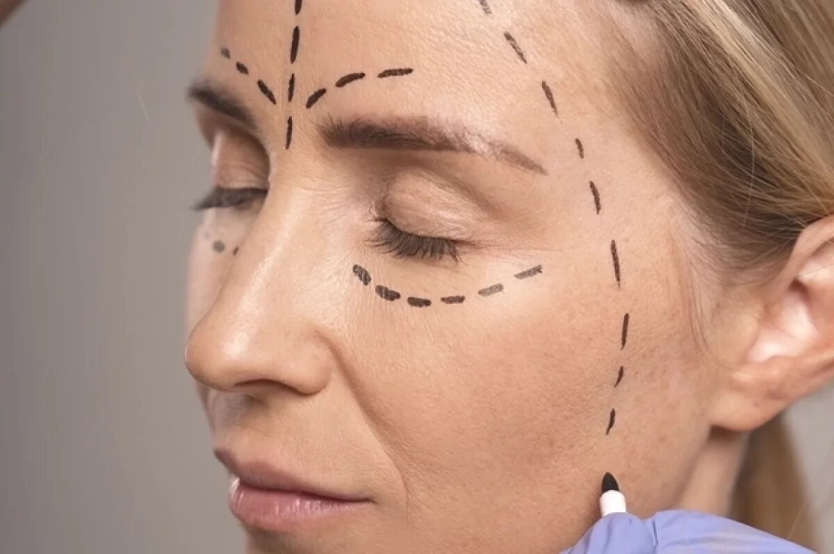    Пластический хирург Рождественская рассказала, как филлеры портят внешность