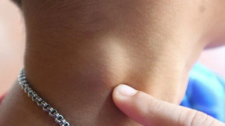 Медленно растет и состоит из жира: что такое липома и опасна ли она?