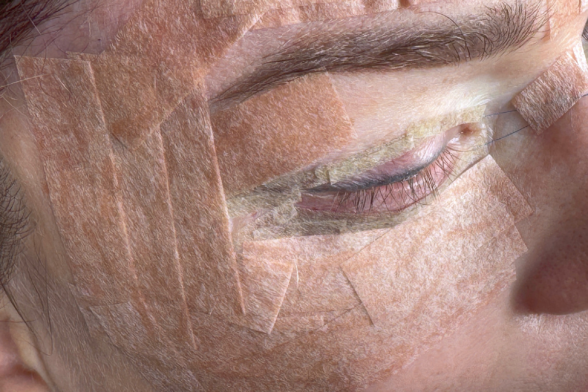 Омоложение верхней трети лица,  пластический хирург Стайсупов В.Ю.