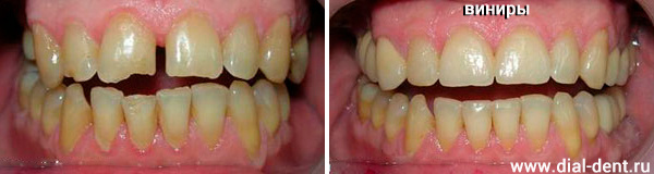 виниры корректируют форму зубов и закрывают щель между зубами