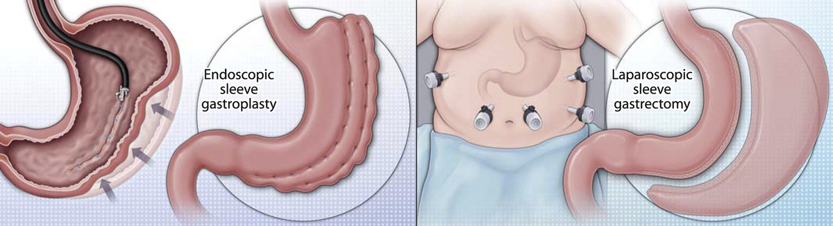 эндоскопическая рукавная гастропластика и лапароскопическая рукавная гастрэктомия (резекция)