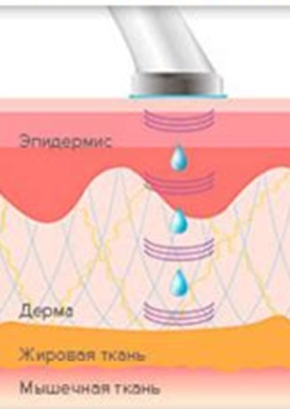 Рис. 02. Фонофорез