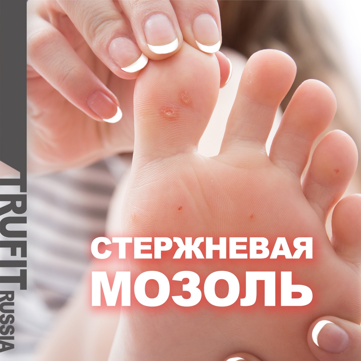 Стержневая мозоль