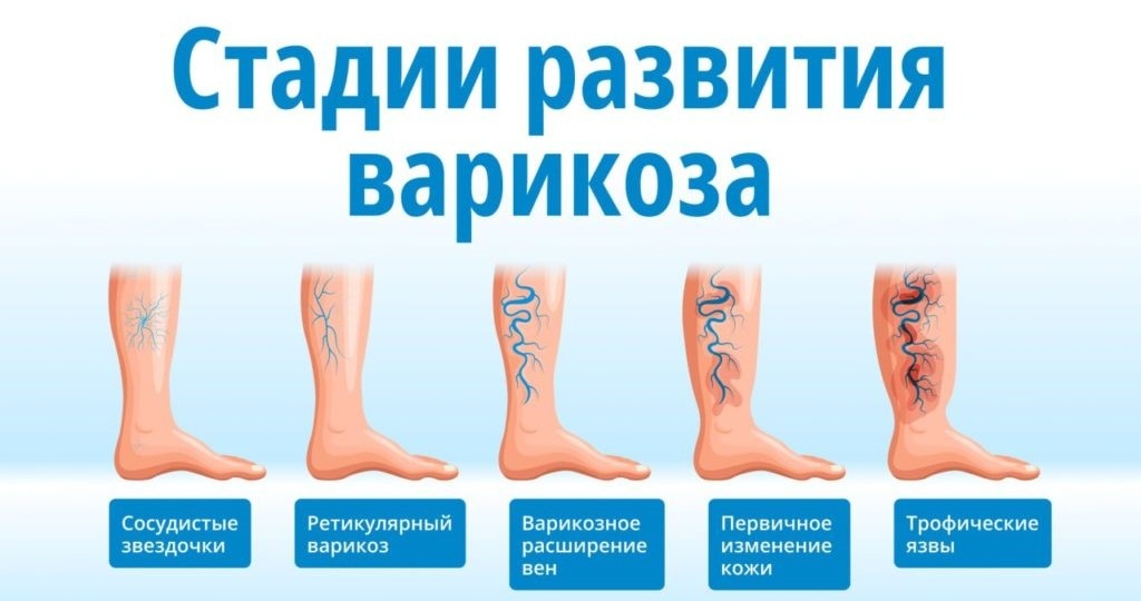 Варикоз: профилактика или лечение? Выбираем правильное направление