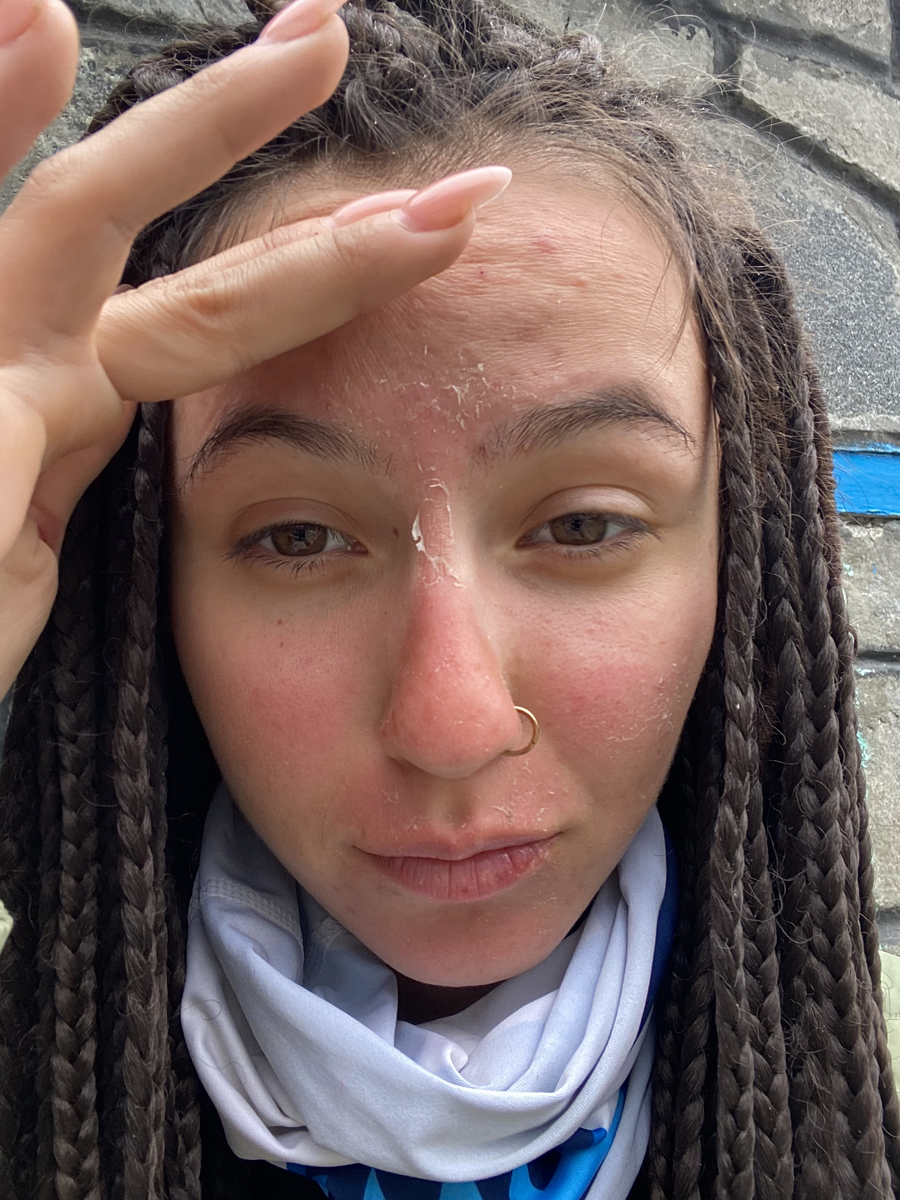 Последствия неправильно выбранного SPF в горном походе налицо. Непал 2023 трек вокруг Аннапурны.