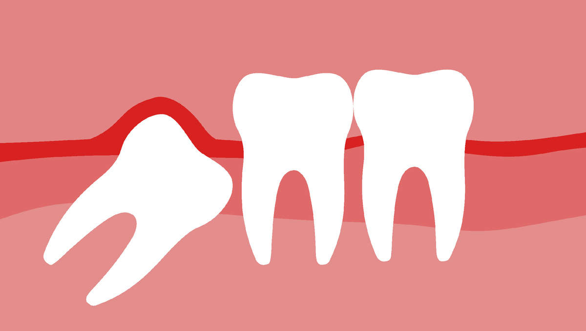 Панорамный рентген-снимок или КТ покажет полную картину, необходимую для принятия решения – что делать с зубом мудрости. 