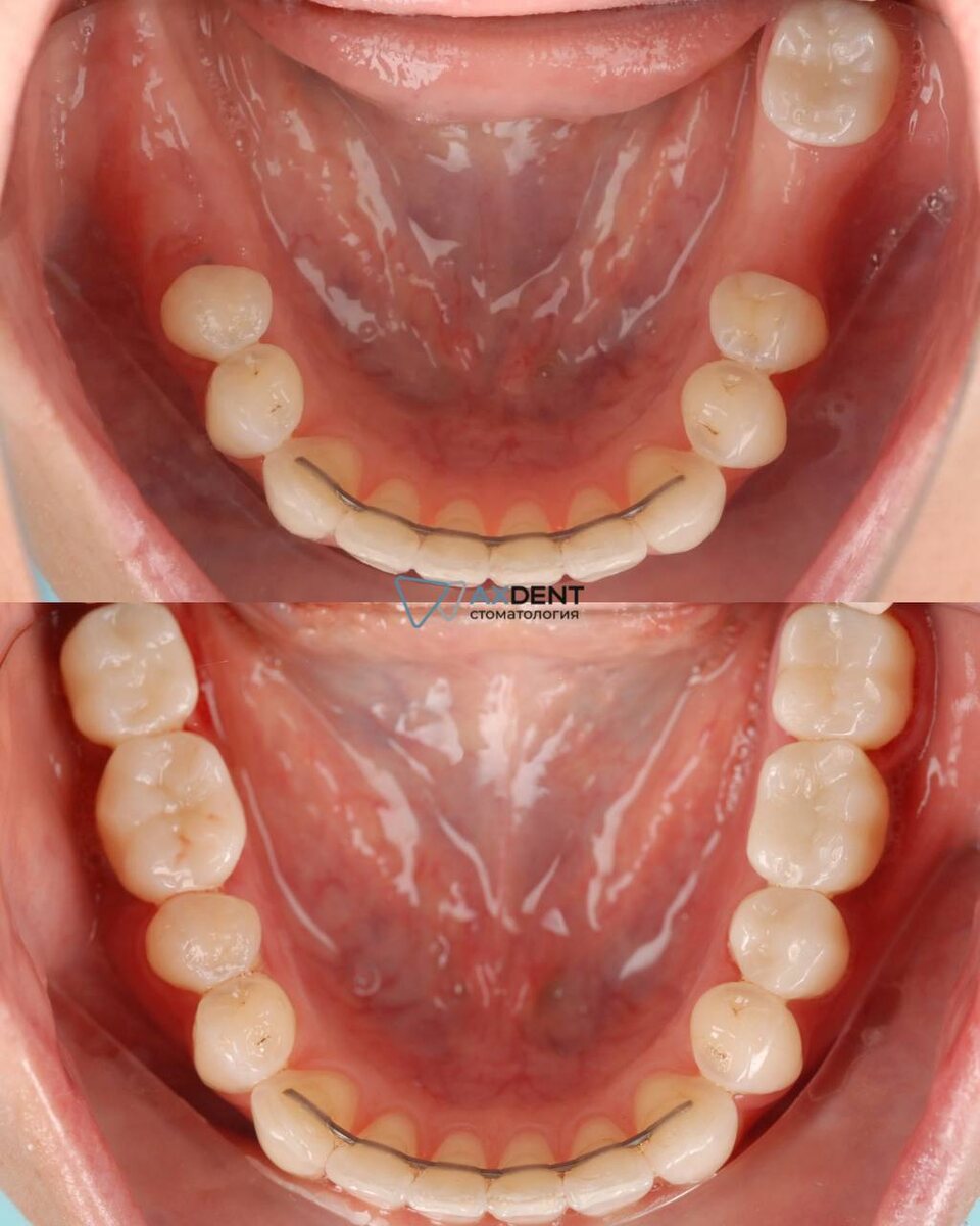 Результат имплантации в клинике AXdent