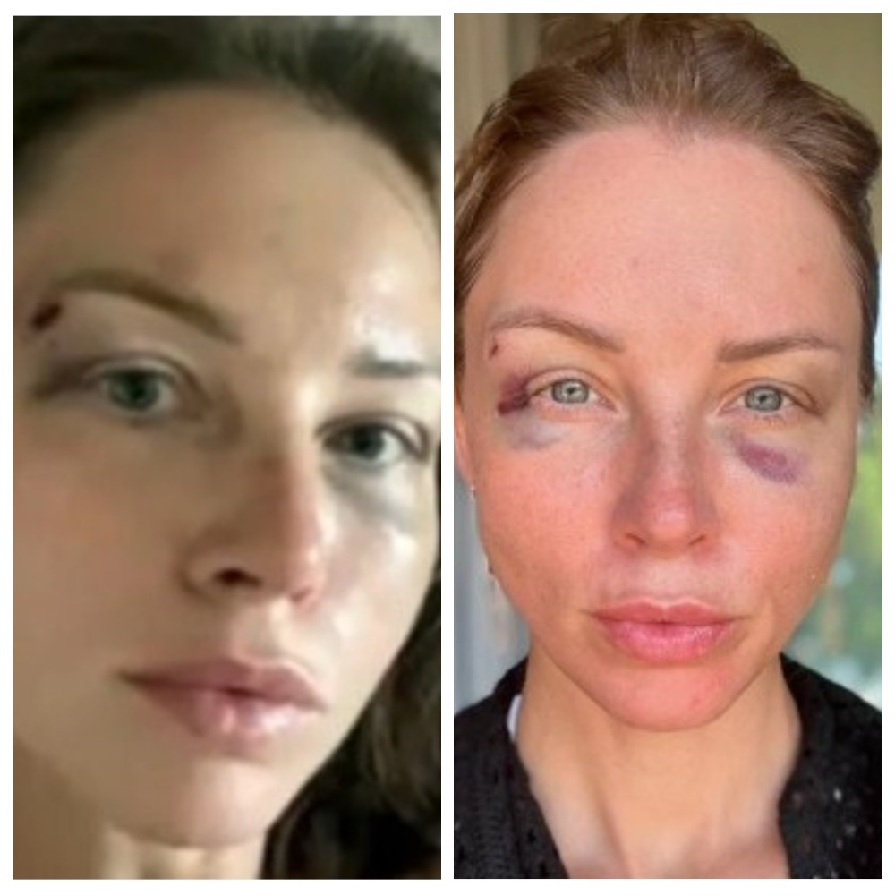 Полина сохранила фото синяков и теперь предъявляет. Для чего?