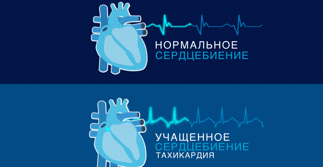 Как остановить учащенное сердцебиение в домашних условиях