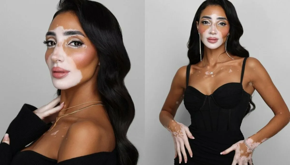 На фото — Логина Салах, египетская модель с витилиго, покорившая соцсети и индустрию красоты своей искренностью и силой. Логина начинала карьеру как визажист в Египте. Она создавала обучающие видео и делала макияж другим женщинам с витилиго — показывая, как подчеркивать, а не прятать особенности внешности. Источник: reporteasia.com