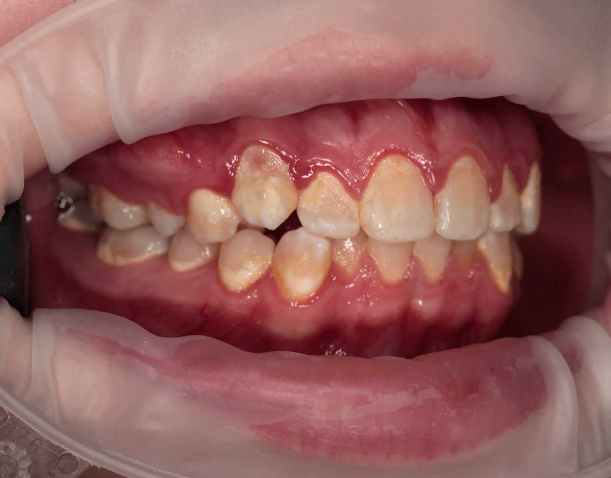 Налёт, кариес, деминерализация