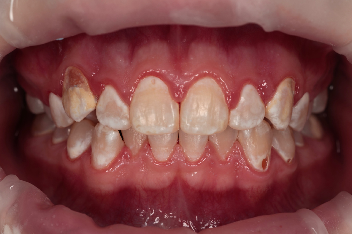 Air-flow и деминерализация, кариес - всё хорошо