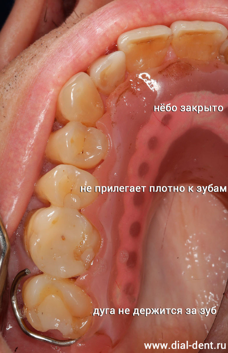 старый частичный съемный протез не прилегает к зубам, ненадежно держится, нарушает речь