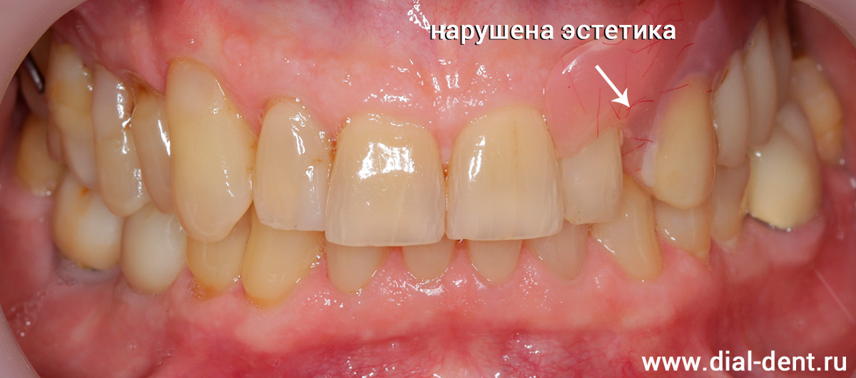 вид со старым съемным протезом зубов - нарушена эстетика, пользоваться протезом неудобно