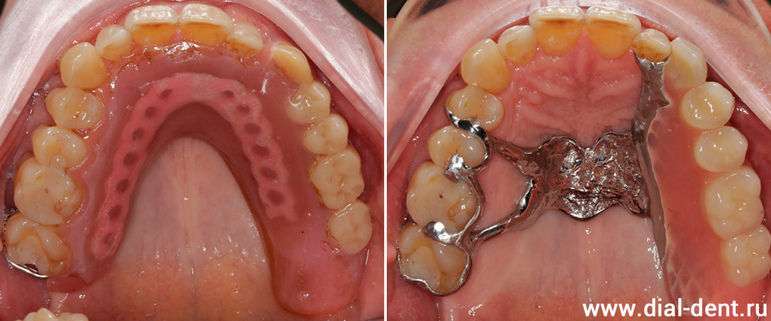 Бюгельный протез - когда имплантация не подходит