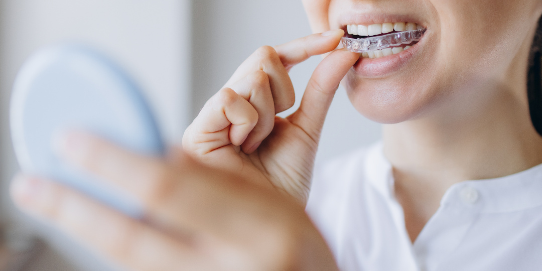 Как элайнеры выравнивают зубы и тренируют силу воли