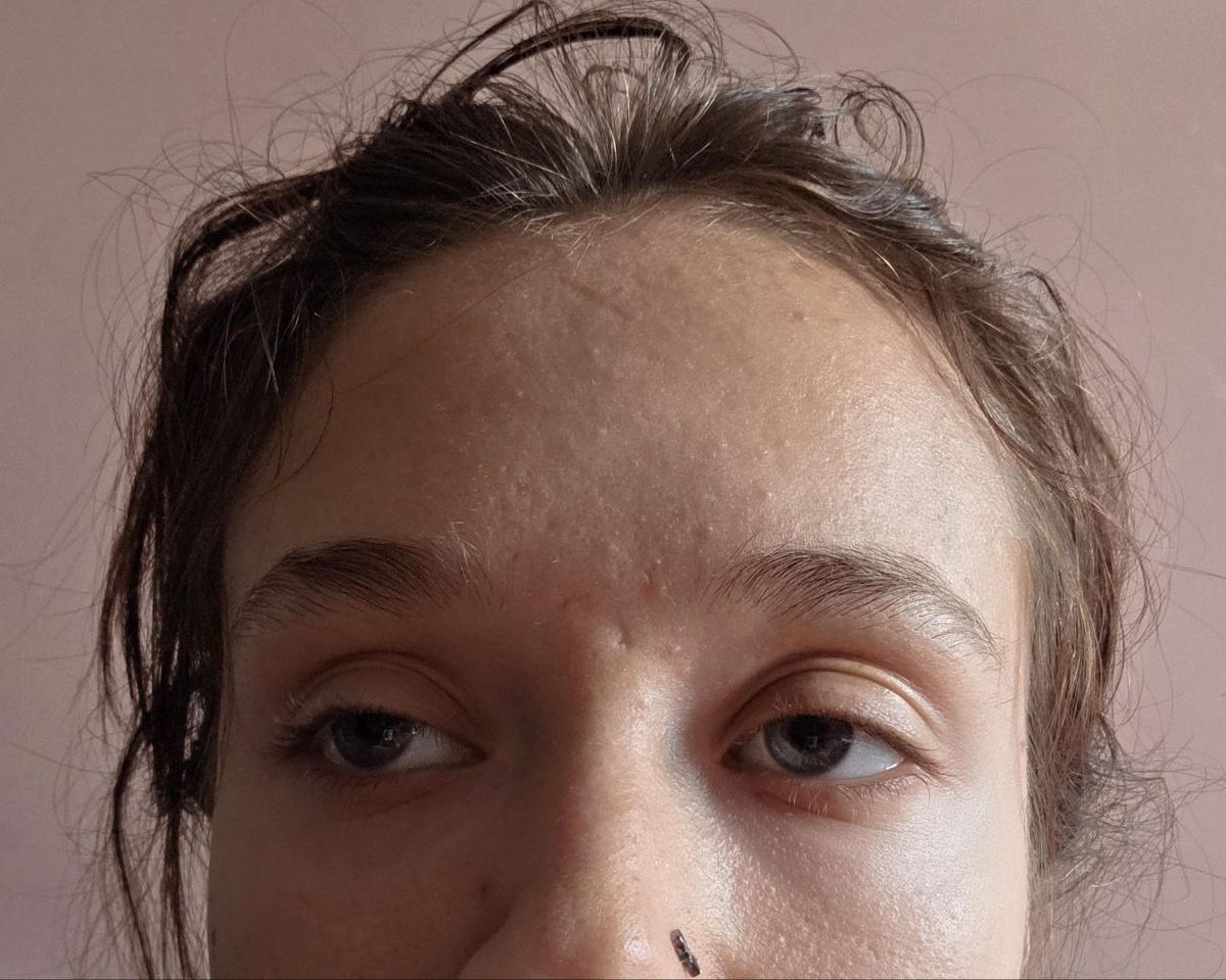 моя кожа после курса системных ретиноидов