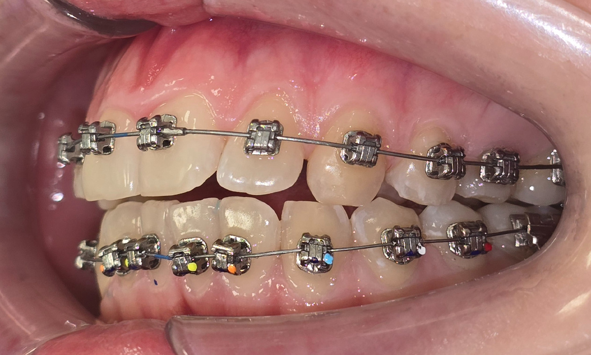 Самолигирующая брекет-система Damon Q2