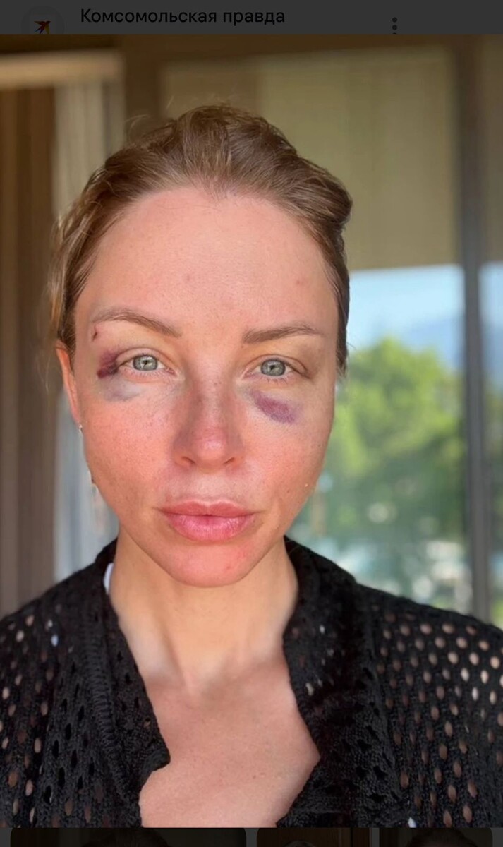 Синяки - последствия блефаропластики