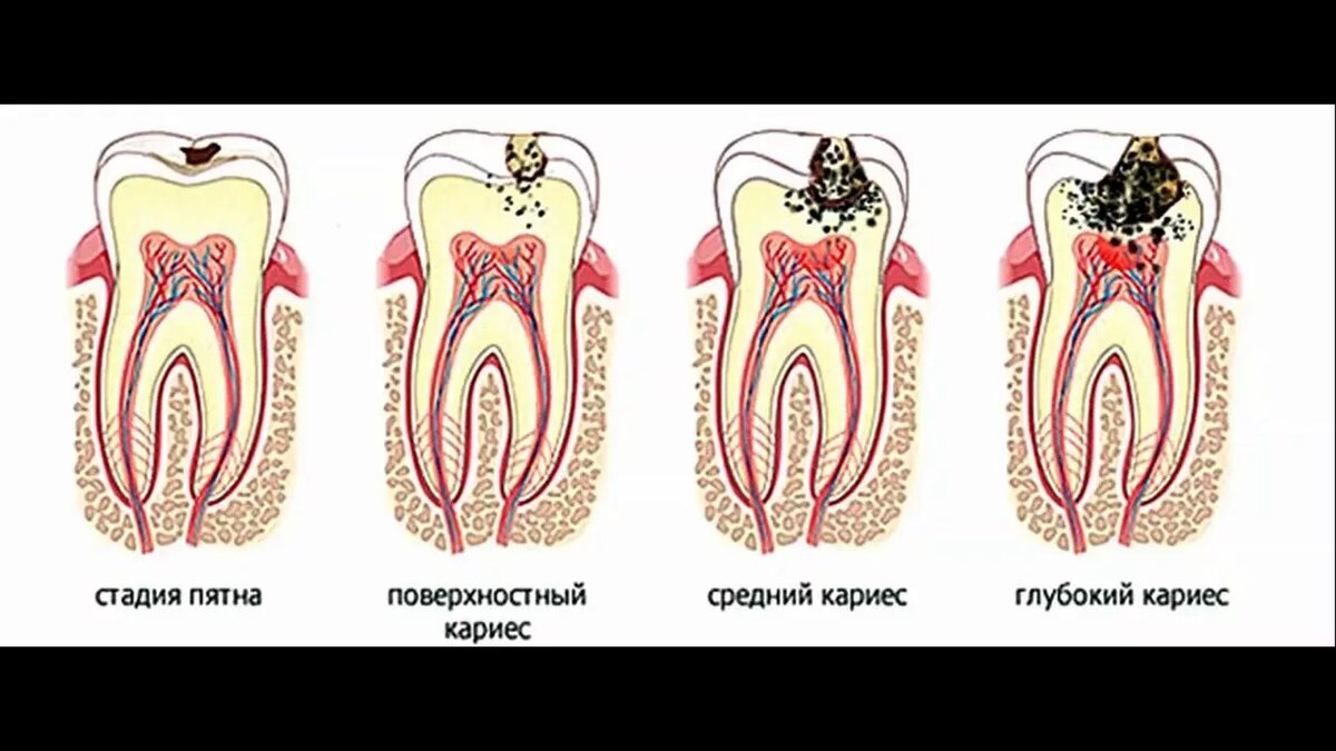 Стадии развития кариеса