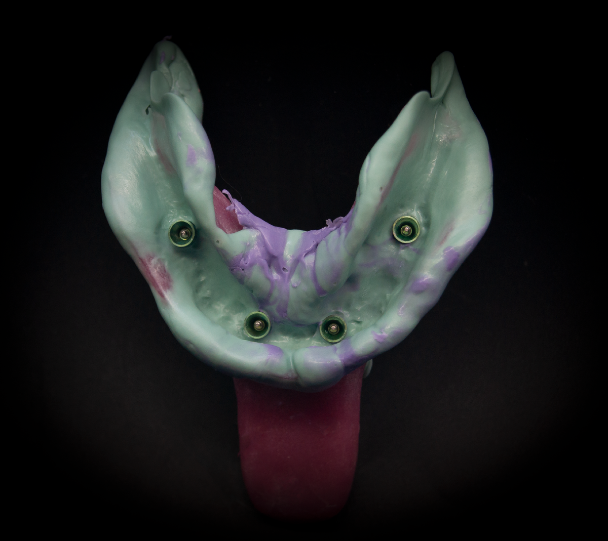 Данные снятые индивидуальной ложкой, нижняя челюсть, с трансфер-чеками внутри.