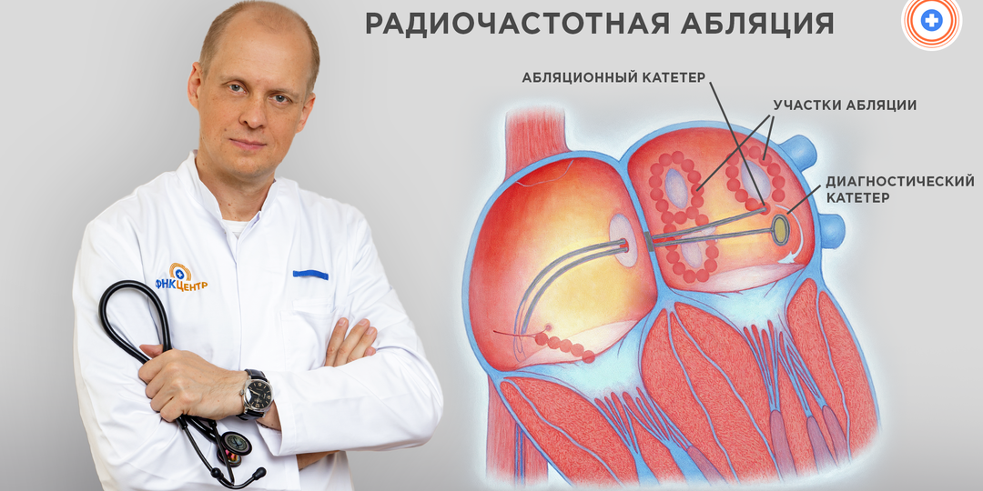 РЧА: современный метод восстановления сердечного ритма