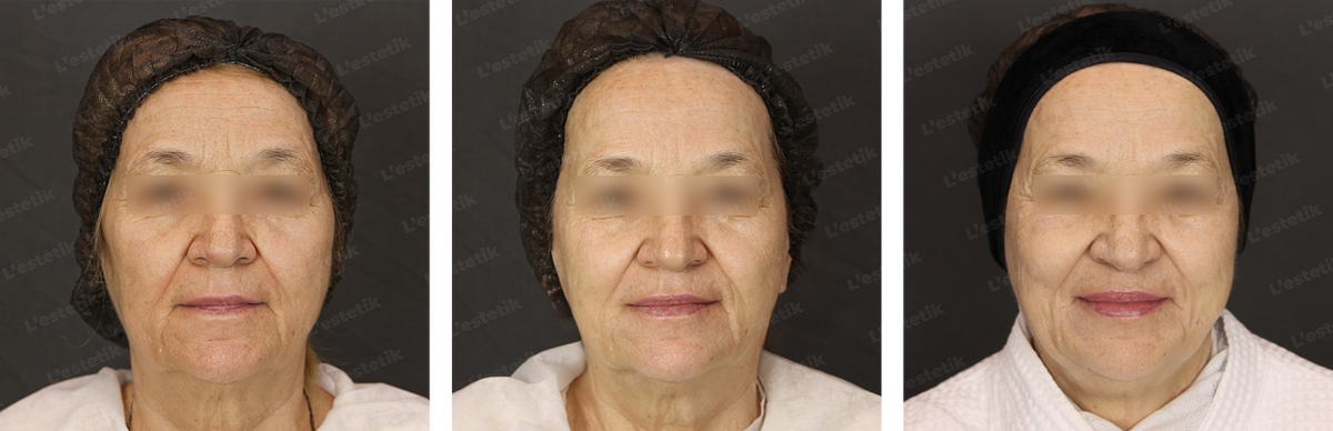 Пациент 1. 71 год