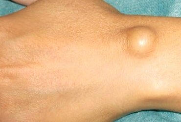 Гигрома лучезапястного сустава