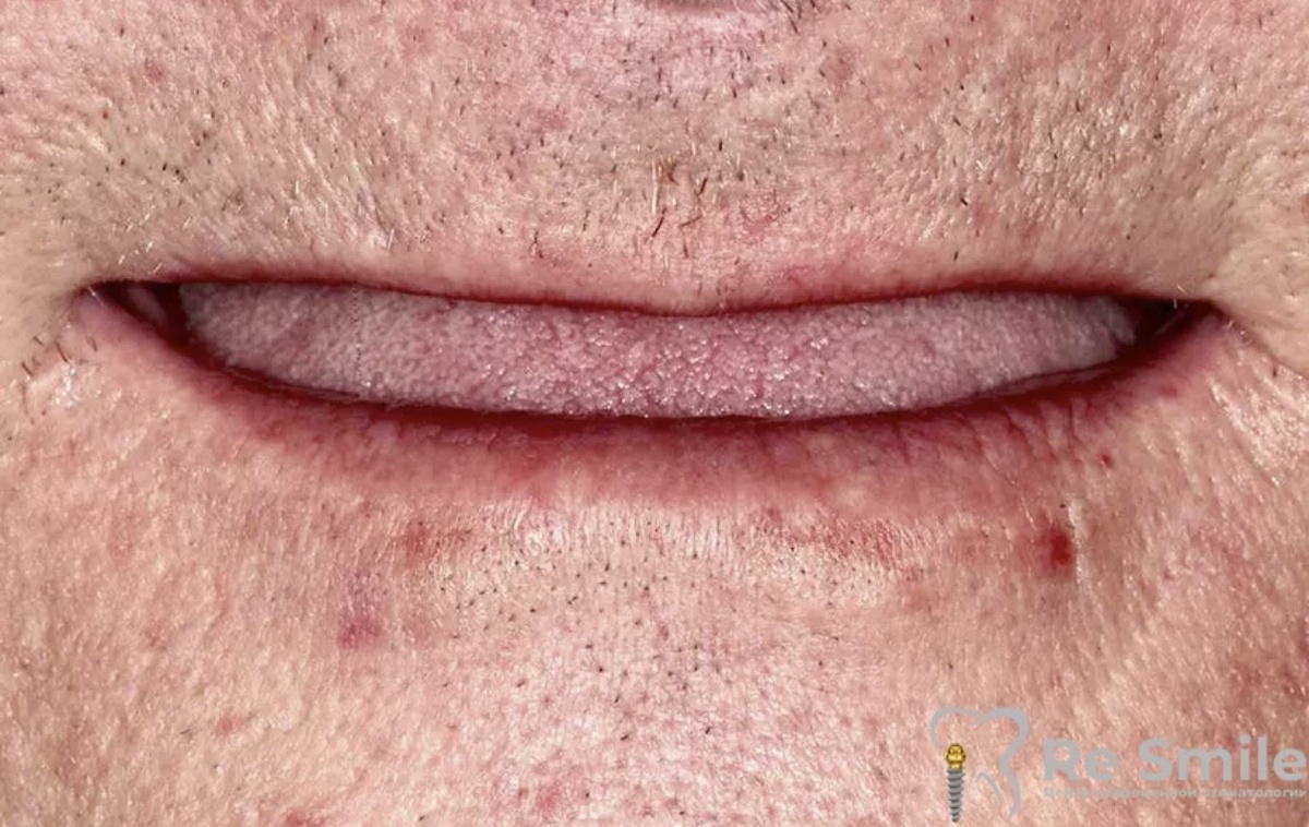 Пациент обратился с жалобами на полное отсутствие зубов и невозможность носить съемные зубные протезы.