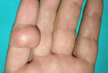 Липомы, атеромы, фибромы