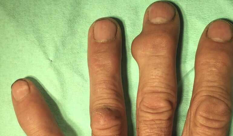 Опухолевидные образования на верхних конечностях – это частая жалоба наших пациентов.