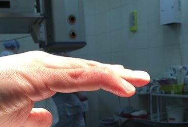 "Палец молоточек"