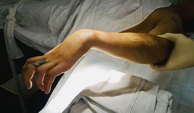 Нейрогенные контрактуры кисти