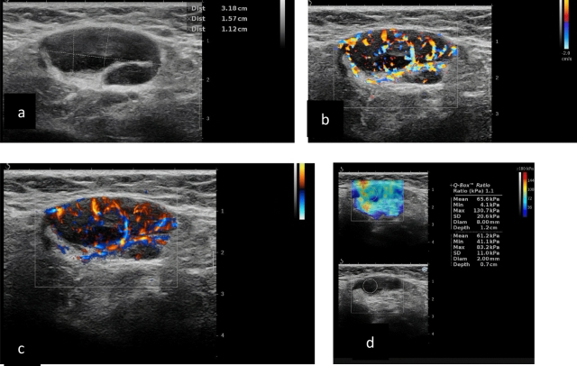 Метастатические подмышечные лимфатические узлы при УЗИ