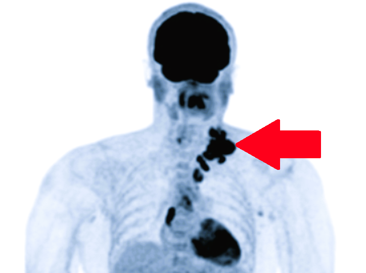 Лимфоузлы при раке: почему они мишень номер 1 при метастазах и как это вовремя обнаружить