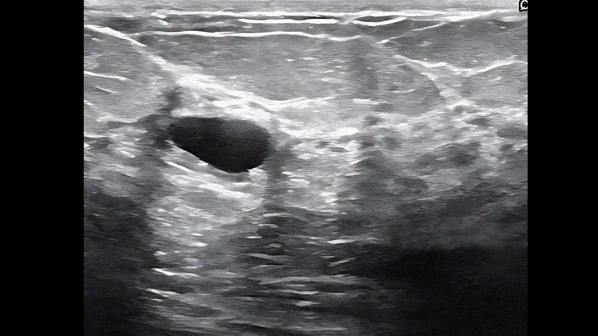 Простая киста молочной железы