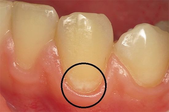 Кариес в стадии белого пятна