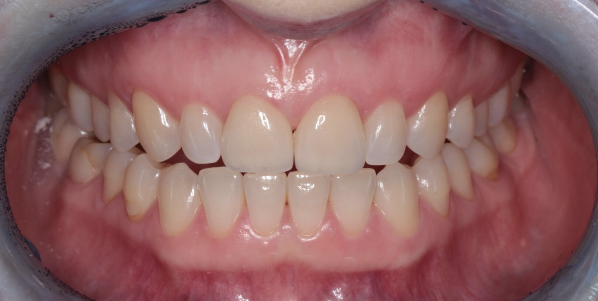 Секреты естественных виниров в Екатеринбурге