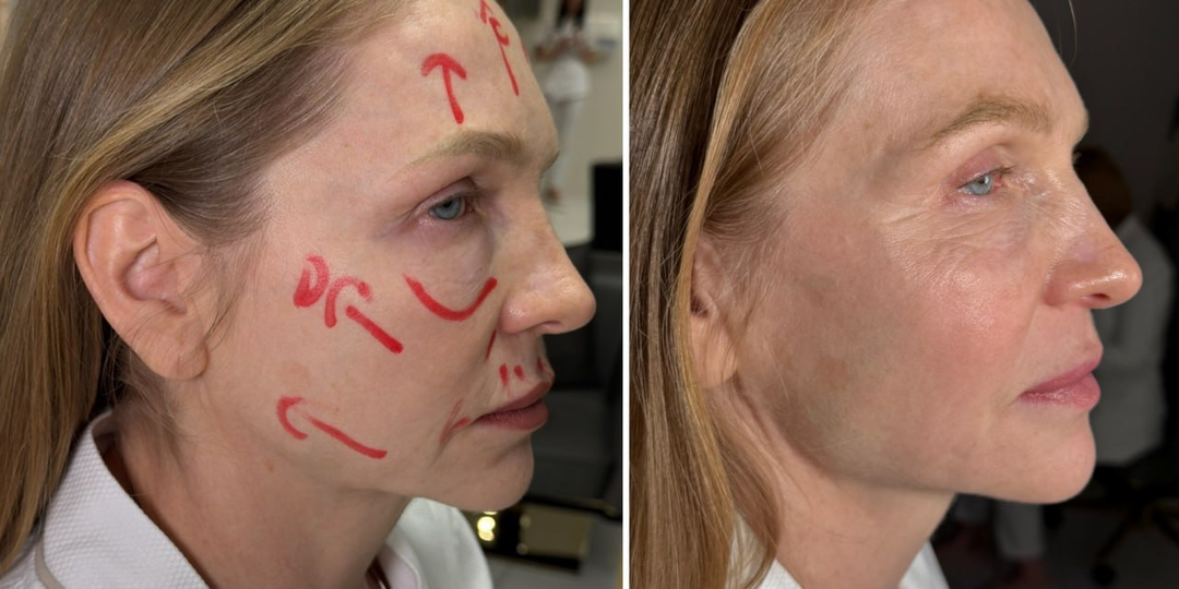 10 частых вопросов о биоревитализации