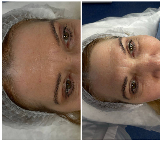 До и после процедуры заполнение глубоких морщин на лбу 