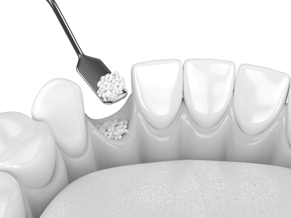 Костная пластика