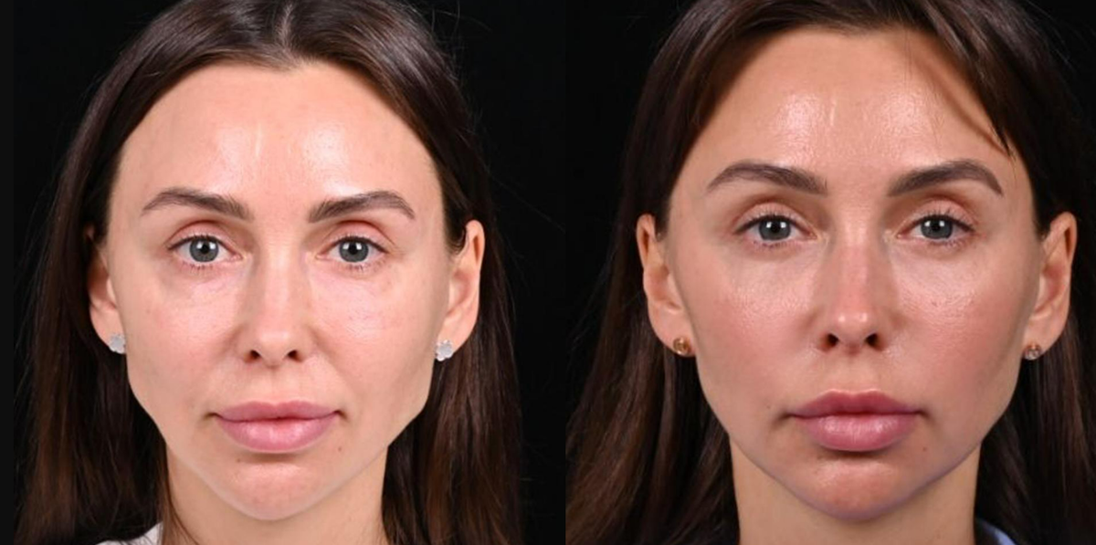 Липофилинг лица фото до и после. Фото с сайта хирурга Д.Р. Гришкяна. Имеются противопоказания, требуется консультация специалиста